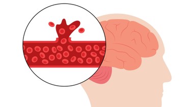 Xuất huyết: Nguyên nhân, triệu chứng và phương pháp điều trị
