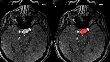 Xuất huyết não sống được bao lâu? Tiên lượng, yếu tố ảnh hưởng và cách phục hồi