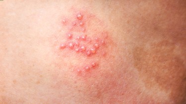 Zona thần kinh có phải là bệnh di truyền? Phòng ngừa bệnh như thế nào?
