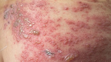 Zona thần kinh ở bụng có đặc điểm gì? Biện pháp để phòng ngừa bệnh
