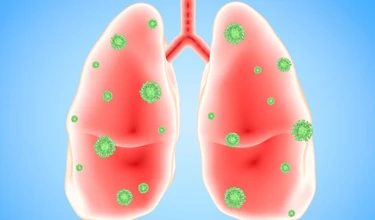 Nhiễm trùng phổi là gì? Nguyên nhân và các triệu chứng điển hình