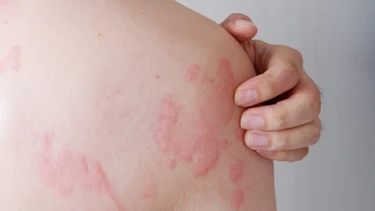 Mề đay: Dấu hiệu, nguyên nhân, phương pháp chẩn đoán, điều trị và phòng ngừa