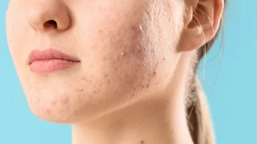 Mụn mủ là gì? Nguyên nhân, triệu chứng và cách điều trị