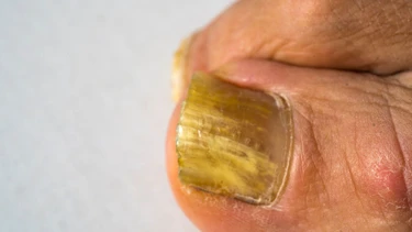 Nâm móng là gì? Những điều cần biết về nấm móng
