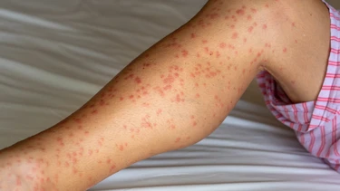 Sẩn giang mai là gì? Dấu hiệu nhận biết, cách điều trị và phòng ngừa