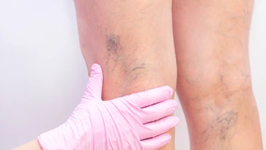 Suy giãn tĩnh mạch là gì? Nguyên nhân và cách phòng ngừa hiệu quả