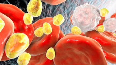 Tăng lipid máu hỗn hợp là gì? Những điều cần biết về tăng lipid máu hỗn hợp