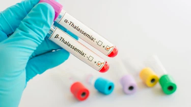 Thiếu máu thalassemia là gì? Những vấn đề cần biết về bệnh thiếu máu thalassemia