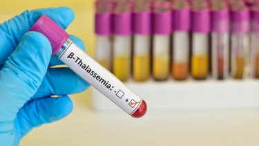 Beta thalassemia​ có triệu chứng gì? Cách điều trị bệnh Beta thalassemia