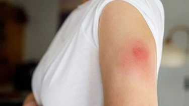 Bị áp xe vết tiêm: Nguyên nhân, dấu hiệu và cách điều trị