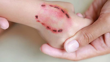 Bị người cắn có sao không? Khi nào cần đi khám ngay?