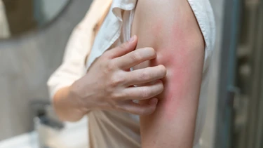 Các bệnh về da mùa hè và cách phòng ngừa hiệu quả