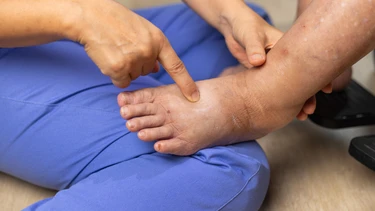 Cách chữa đau mu bàn chân: Xử trí đúng và khi nào cần đi khám?