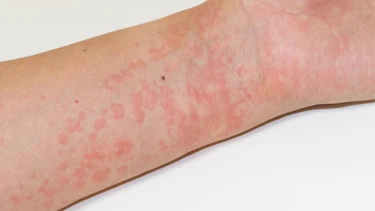 Cách chữa dị ứng thời tiết nổi mề đay an toàn và hiệu quả