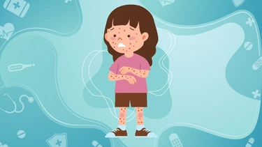 Cảnh giác với bệnh Rubella: Không chỉ là sốt phát ban thông thường!