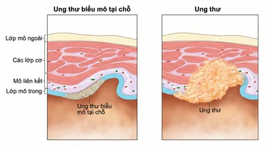 Carcinoma có nguy hiểm không? Giải đáp đầy đủ để chủ động bảo vệ sức khỏe