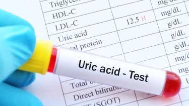 Chỉ số Acid uric là gì? Ý nghĩa và mức bình thường bạn cần biết