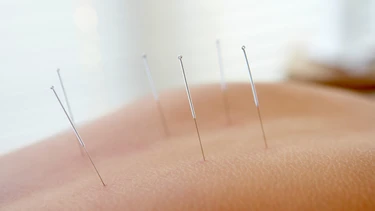 Chữa tự kỷ bằng châm cứu có hiệu quả không?