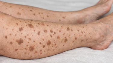 Da chân bị đốm nâu: Nguyên nhân, dấu hiệu và cách chăm sóc giúp cải thiện an toàn