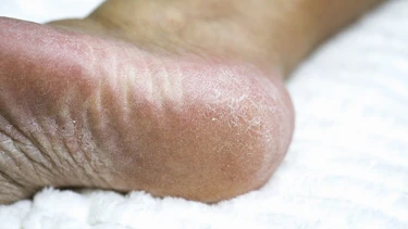 Da chân bị khô như da rắn là gì? Cách xử lý và phòng ngừa hiệu quả