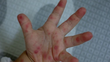 Dịch tay chân miệng đang “nóng” trở lại với tốc độ đáng lo