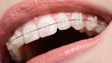 Giai đoạn xấu nhất khi niềng răng là khi nào? Những điều cần lưu ý