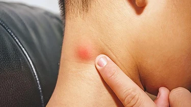Hạch lành tính bao lâu thì hết? Dấu hiệu nhận biết