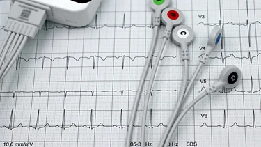 Hội chứng WPW là gì? Nguyên nhân, dấu hiệu và cách chẩn đoán