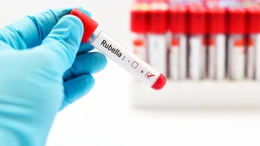Kết quả Rubella IgM dương tính là gì? Cần làm gì khi có kết quả Rubella IgM dương tính?