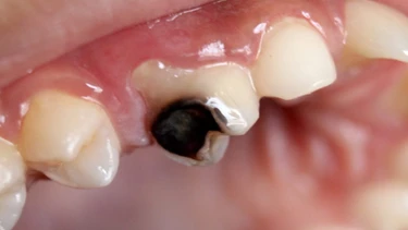 Làm gì khi trẻ bị sâu răng sữa và cách xử lý đúng đắn cha mẹ cần biết