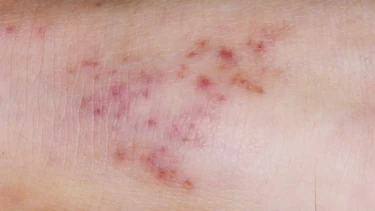 Làm gì sau khi tiếp xúc người bị nhiễm viêm não mô cầu?