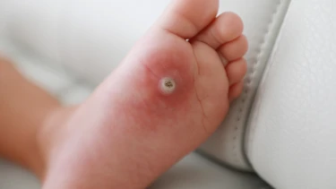 Mẹo chữa mụn cóc dân gian có hiệu quả không? Cách áp dụng an toàn