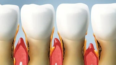 Mòn cổ chân răng là gì? Những điều cần biết về mòn cổ chân răng