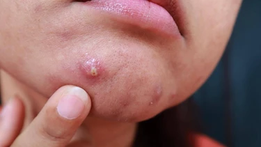 Mụn bọc mủ​: Nguyên nhân, cách xử lý và phòng ngừa