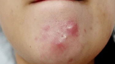 Cách xử lý và phòng ngừa mụn chai​ không phải ai cũng biết