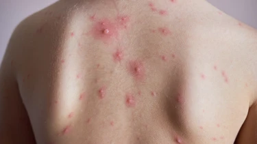 Mụn nước tay chân miệng và thủy đậu: Cách phân biệt rõ ràng qua dấu hiệu điển hình