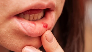 Mụn nước trong miệng là gì? Nguyên nhân và cách xử trí an toàn