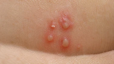 Mụn rộp sinh dục giai đoạn đầu: Dấu hiệu dễ nhận biết