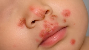 Mụn rộp sinh dục ở trẻ em: Dấu hiệu cần đi khám