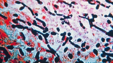 Nhiễm nấm Candida: Triệu chứng, nguyên nhân, chẩn đoán, điều trị và phòng ngừa