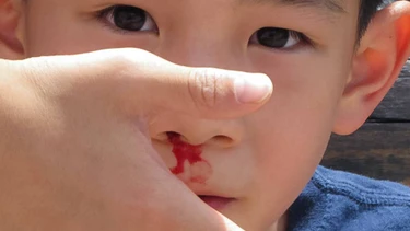 Nguyên nhân trẻ bị chảy máu mũi 1 bên và cách xử lý hiệu quả
