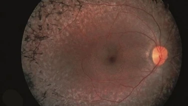 Nguyên nhân và triệu chứng viêm võng mạc sắc tố là gì?