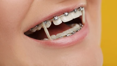 Niềng răng bao nhiêu tiền 2 hàm? Cập nhật chi phí mới nhất