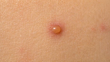 Nổi mụn nước không ngứa là gì? Nguyên nhân và cách xử trí an toàn