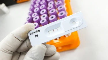 Parvovirus B19: Những điều cần biết về triệu chứng, lây truyền và cách phòng ngừa