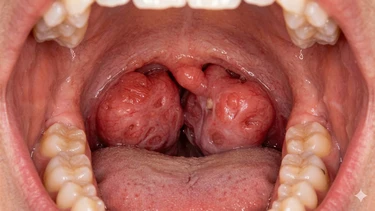 Polyp vòm họng là gì? Nguyên nhân, dấu hiệu và cách điều trị thường gặp