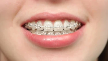Răng đã lấy tủy có niềng được không? 5 điều phải biết trước khi niềng