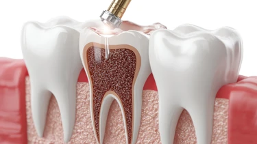 Răng lấy tủy có bị tiêu xương không? Dấu hiệu cảnh báo
