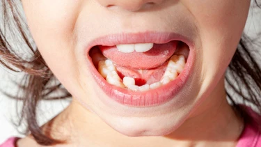 Răng sữa chưa rụng đã mọc răng mới: Xử lý sao để không lệch hàm?