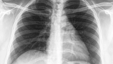 Rốn phổi đậm là gì? Nguyên nhân, mức độ nguy hiểm và khi nào cần đi khám